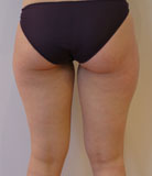 Avant lipoaspiration