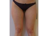 Avant lipoaspiration