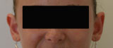 Patiente avant otoplastie