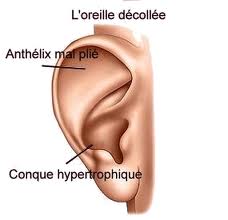 chirurgie oreille decollee