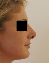 Après rhinoplastie