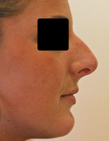 Avant rhinoplastie
