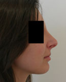 Chirurgie esthetique rhinoplastie