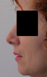 Patiente après chirurgie : rhinoplasite esthetique avec diminution de la bosse et de la longueur du nez pour un résultat naturel.