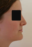 Après rhinoplastie