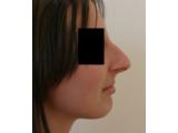 Chirurgie esthetique rhinoplastie