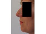 Patiente avant rhinoplastie
