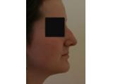 Avant rhinoplastie