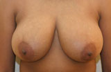 Hypertrophie mammaire avant chirurgie
