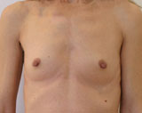 avant pose d'implants mammaires