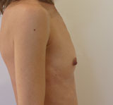 Avant chirurgie des seins