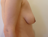 Avant lifting des seins et augmentation mammaire
