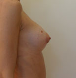 Augmentation mammaire, hypotrophie mammaire