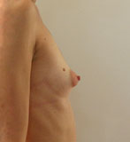 Patiente avant chirurgie pour pose d'implants mammaires