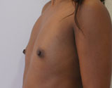 Patiente avant chirurgie pour augmentation mammaire