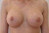 Implants mammaires anatomiques