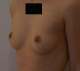 Avant chirurgie pour augmentation mammaire