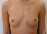 Avant Chirurgie