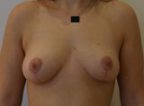 Après lifting des seins