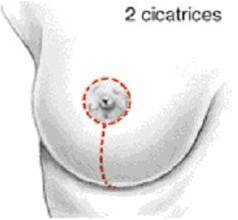 Réduction mammaire à cicatrice verticale