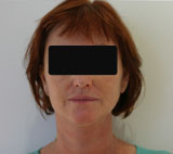 Patiente après chirurgie : lifting cervico facial avec remisne en tension du cou et de l'ovale du visage.