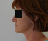 Patiente après chirurgie : lifting cervico facial avec remisne en tension du cou et de l'ovale du visage.