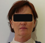 Patiente avant chirurgie pour rajeunissement facial