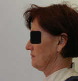 Patiente avant chirurgie pour rajeunissement facial