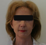 Patiente après chirurgie par lifting cervico facial et blépharoplastie inférieure.