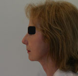 Patiente après chirurgie pour rajeunissement facial