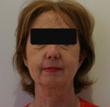 Patiente avant chirurgie pour rajeunissement facial