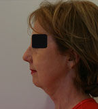 Patiente avant lifting cervico facial