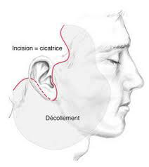 cicatrice lifting visage